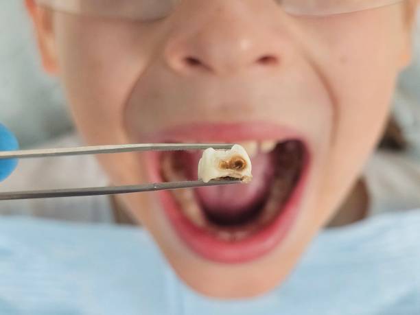 Best Tooth Infection Emergency Dentist  in Doniphan, MO